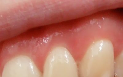 Psoriasis et maladie de gencive