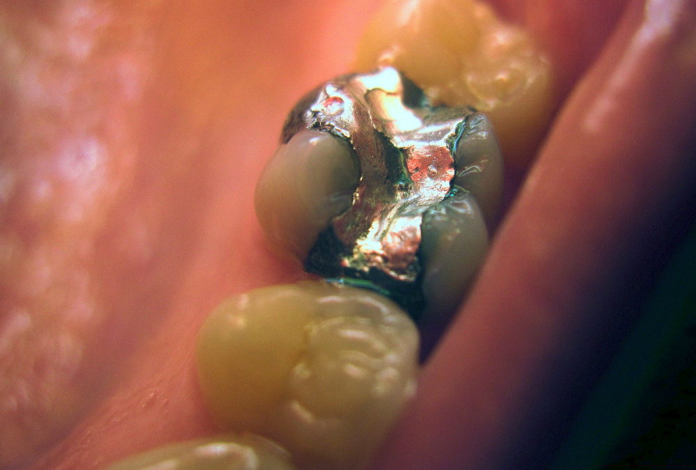 Amalgames dentaires au mercure : faut-il les faire enlever ?