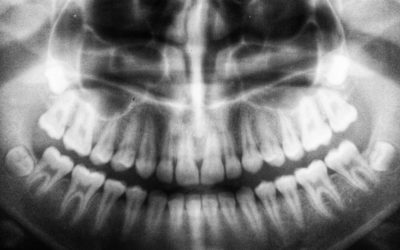 Dents dévitalisées et maladie