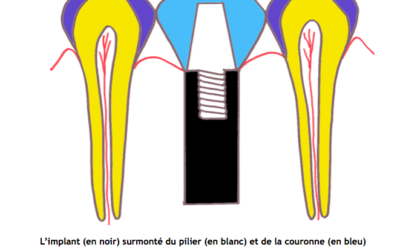 Conserver ou extraire les dents dévitalisées ?