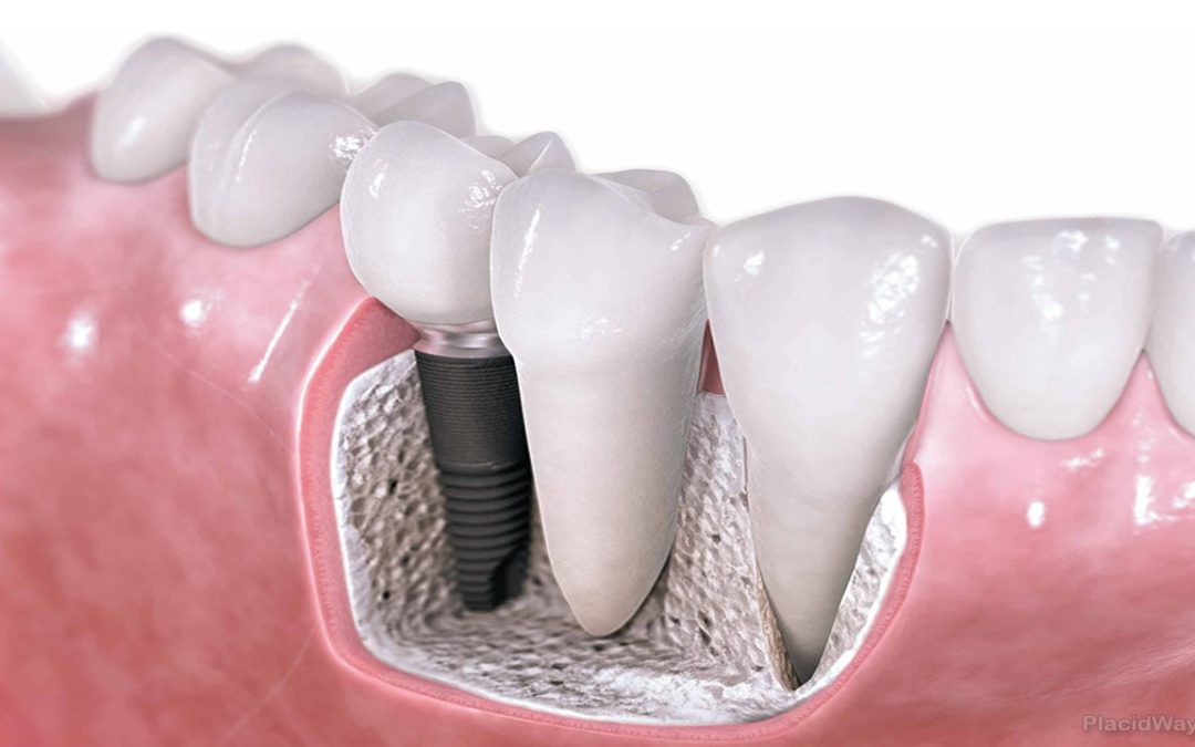 Implants dentaires : titane ou zircone ?